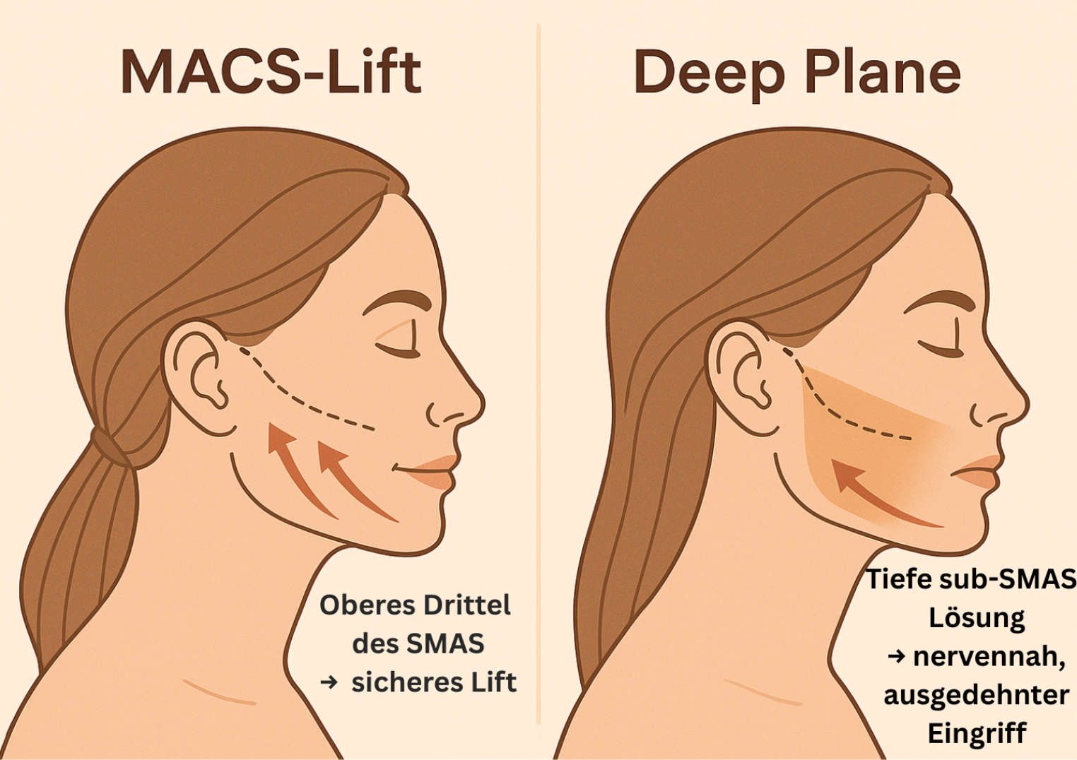 erläuterung skizze deep plane facelift düsseldorf