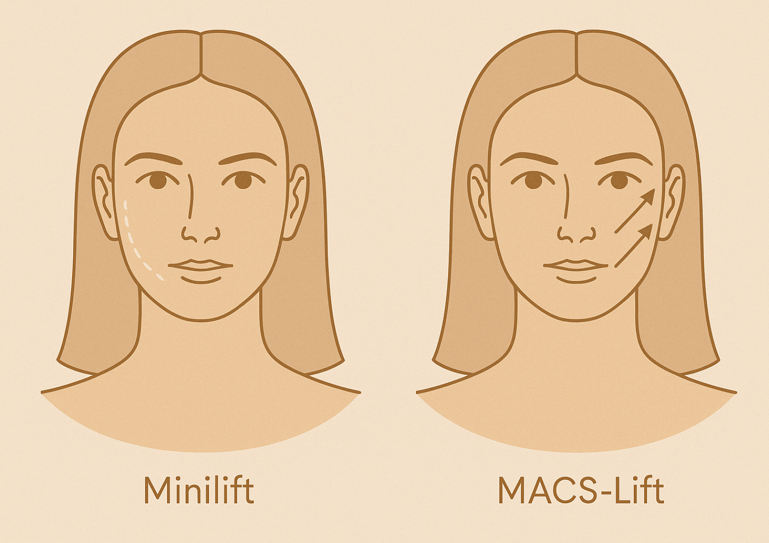 Vektoren-Minilift-im-Vergleich-zu-MACS-Lift Vektorgrafik für Minilift im Vergleich zu MACS-Lift